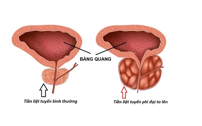 các loại thuốc đặc trị phì đại tuyến tiền liệt