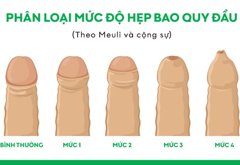 cắt bao quy đầu bị hẹp