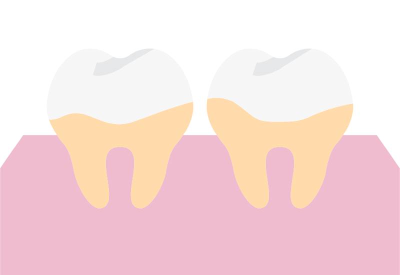 Cao răng là lớp cứng bám chặt trên bề mặt răng, thường ở gần nướu.