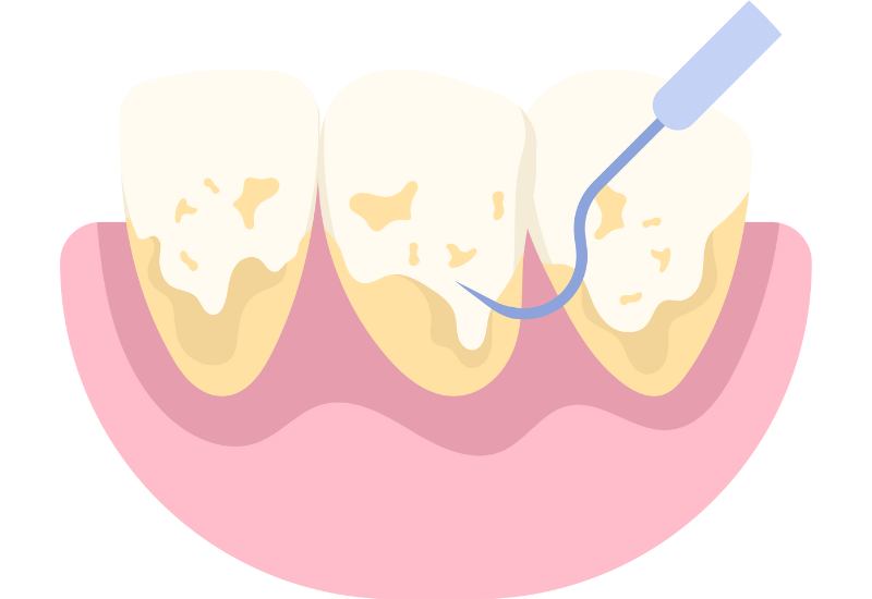 Cao răng là gì? Cao răng hay calculus, là một lớp vật chất cứng, tích tụ trên bề mặt răng.