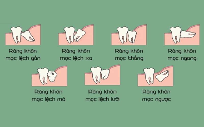 chi phí nhổ răng khôn bao tiền