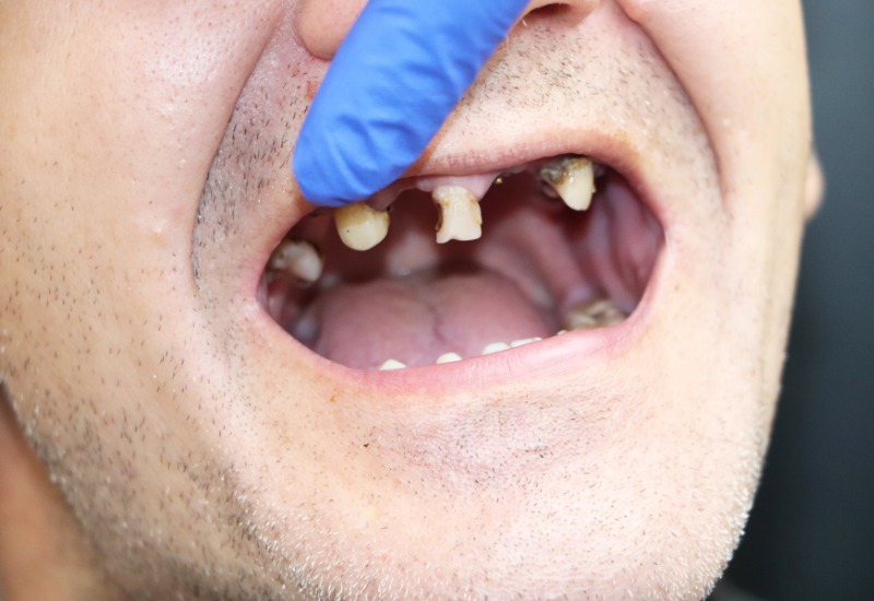 Sâu răng là bệnh lý nha khoa có thể gây đau đớn đáng kể cho người bệnh.