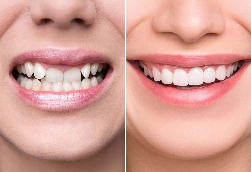 Có nên bọc răng sứ không các bạn