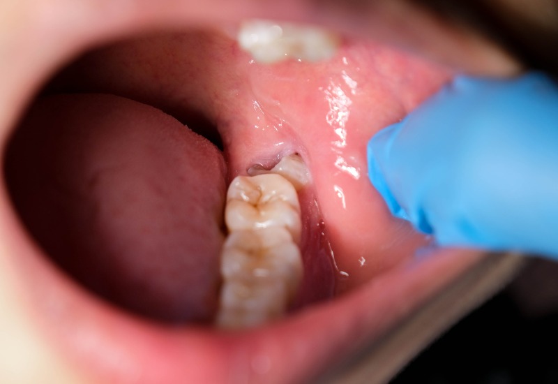 Răng khôn mọc ngầm dưới nướu, gây áp lực lên các răng liền kề, dẫn đến đau nhức, và nhiều vấn đề khác trong quá trình sinh hoạt hàng ngày.