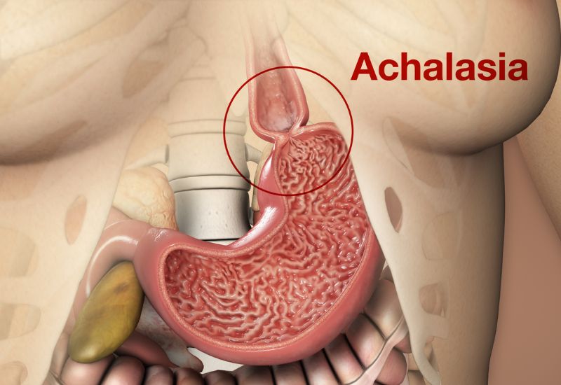 Vai trò của đo HRM trong việc phân biệt các bệnh lý có triệu chứng tương tự GERD