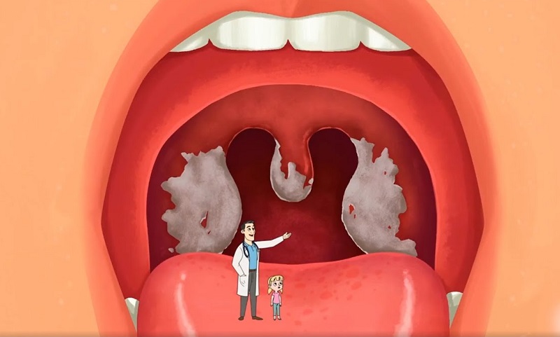 Dấu hiệu bệnh bạch hầu và viêm họng không hoàn toàn giống nhau