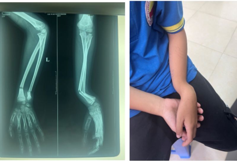 dấu hiệu nhận biết gãy xương