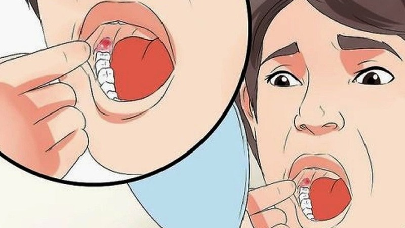 Đau nướu răng trong cùng là bệnh gì