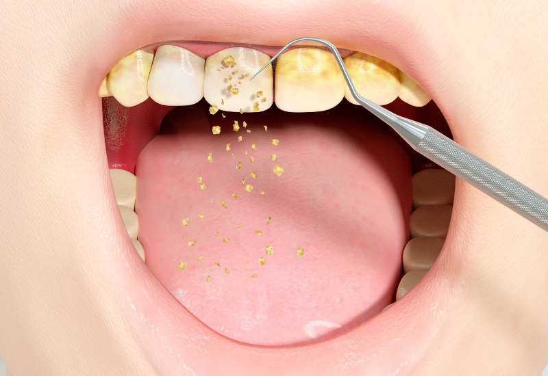 Cao răng là một lớp cứng bám trên bề mặt răng và dưới viền nướu.