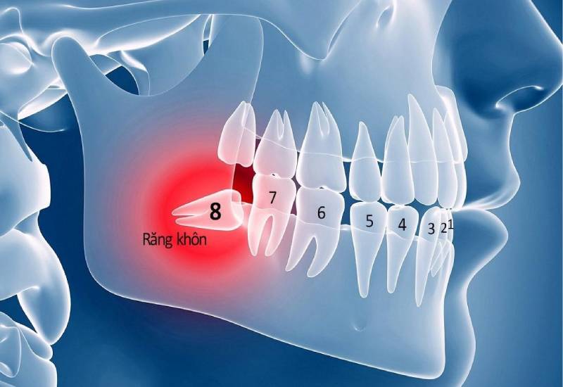 khi nào nên nhổ răng khôn phù hợp