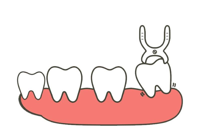 Bạn Nên nhổ răng khôn không