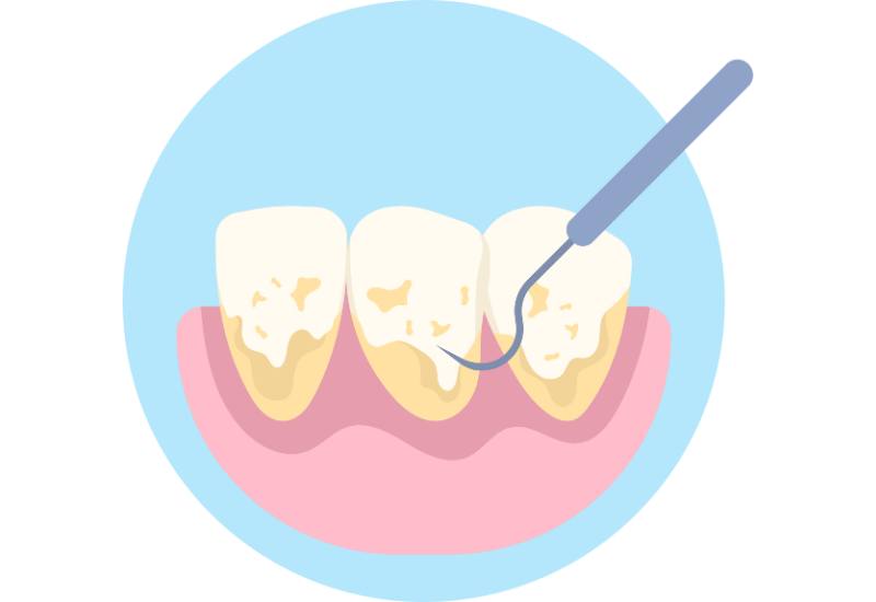 Nguyên nhân bị vôi răng liên quan đến sự tích tụ mảng bám và các khoáng chất trong nước bọt.