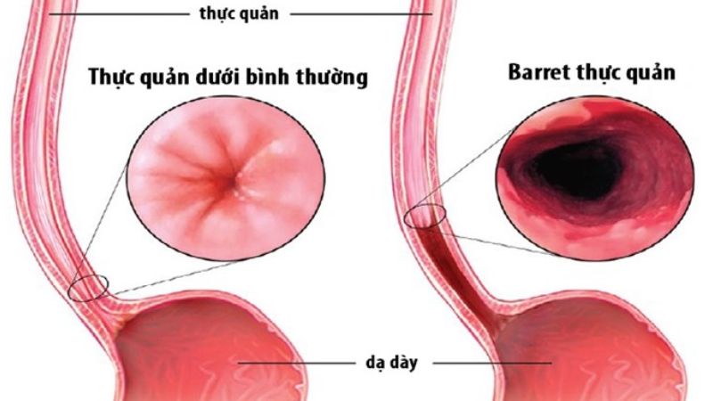 Nguyên nhân gây khó nuốt thức ăn