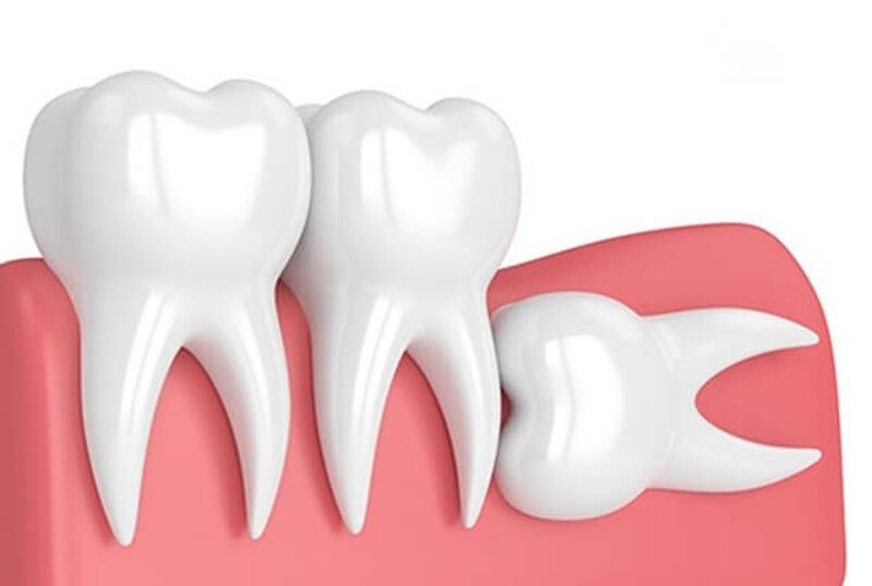 nhổ răng số 8 giá bao nhiêu hiện nay