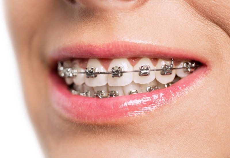Niềng răng là một phương pháp thẩm mỹ nha khoa, được thực hiện nhằm điều chỉnh vị trí các răng cũng như cách các răng khớp nhau.