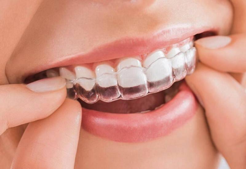 niềng răng mất bao lâu hả