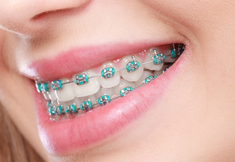 Niềng răng hay chỉnh nha, là một phương pháp thẩm mỹ nha khoa được thực hiện nhằm sắp xếp lại răng và khớp cắn, giúp cải thiện cả chức năng ăn nhai lẫn thẩm mỹ của răng và hàm.