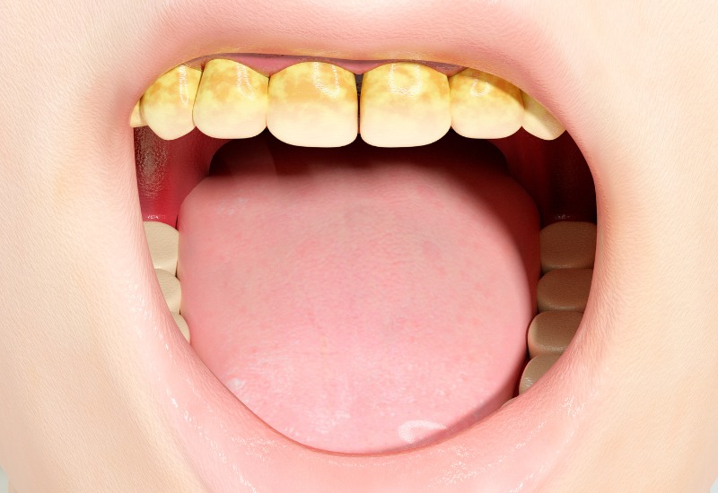 Cao răng là một lớp cứng bám trên bề mặt răng, hình thành từ mảng bám đã khoáng hóa, với mảng bám là một lớp mềm bám trên bề mặt răng, lớp này chủ yếu bao gồm vi khuẩn, và thức ăn thừa.