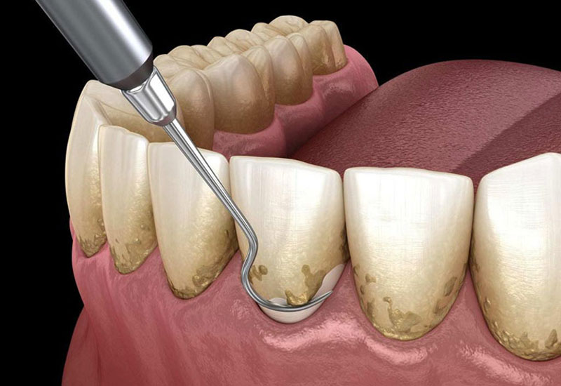 Phí lấy cao răng như thế nào 