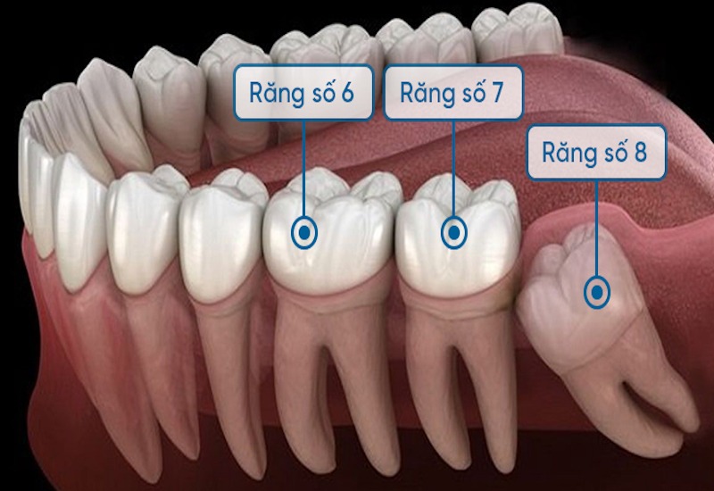 răng khôn mọc lệch có nên nhổ không bác sĩ