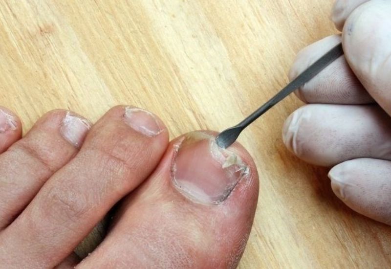 bị móng quặp tuyệt đối không nên tự ý nặn khoét mủ.