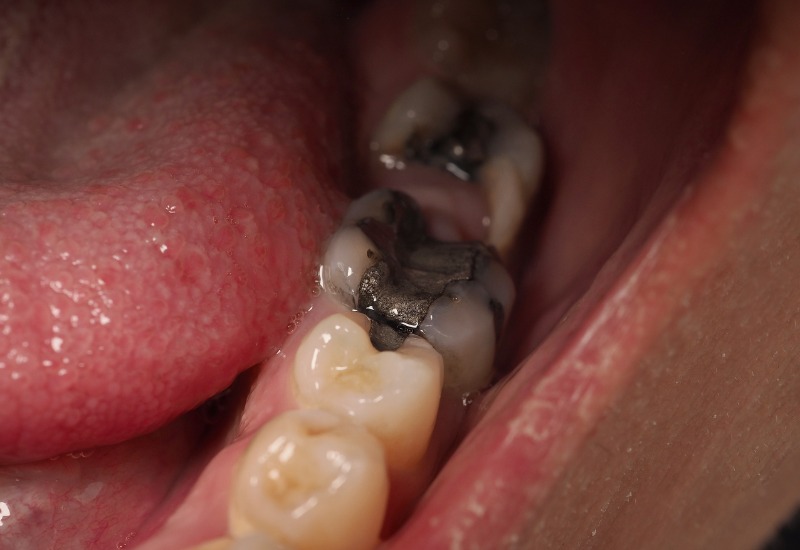 Như đã chia sẻ phía trên, sâu răng bị lồi thịt không phải là một thuật ngữ chính thức trong nha khoa, nó thường được sử dụng để mô tả tình trạng sâu răng nghiêm trọng, khi mà phần sâu của răng đã phá hủy nhiều mô răng và tiến triển vào các lớp trong, ảnh hưởng đến mô mềm xung quanh, như nướu và các mô lân cận khác.