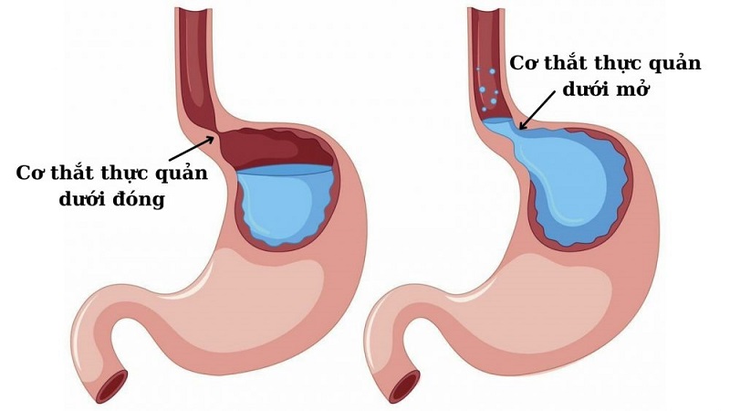 Nguyên nhân gây các triệu chứng trào ngược