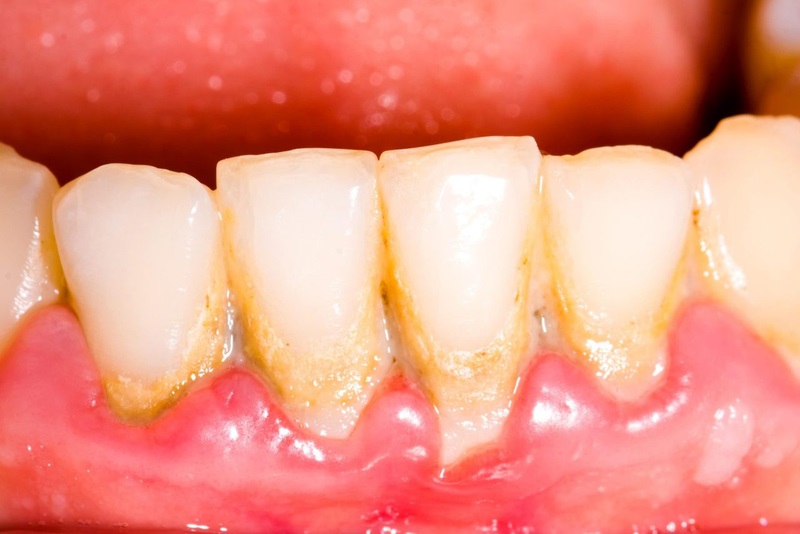 Mảng bám có thể hình thành cao răng và gây hôi miệng.