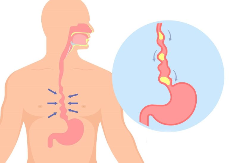 Biến chứng trào ngược dạ dày và triệu chứng