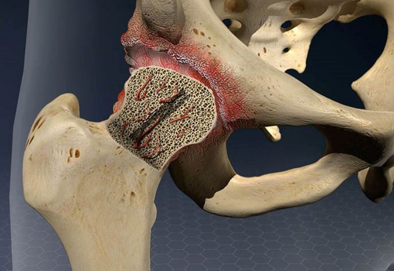 trật khớp háng biến chứng
