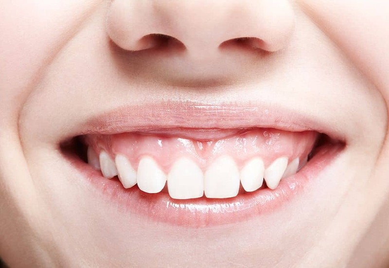 Cười hở lợi là tình trạng mà khi cười, lợi và răng lộ ra nhiều hơn sơ với bình thường.