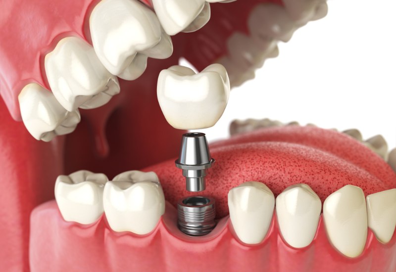 Trong phương pháp implant, một trụ implant thường làm từ titan được cấy vào xương hàm tại vị trí mất răng.