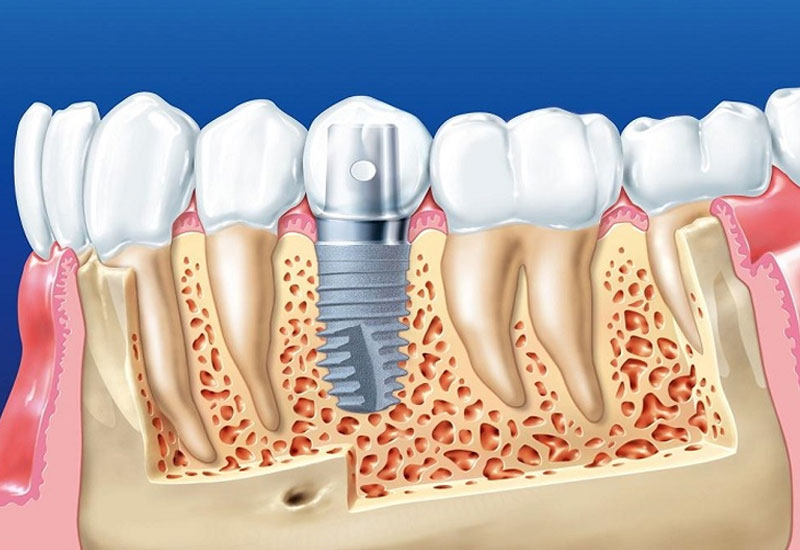 Trồng răng sứ đắt không