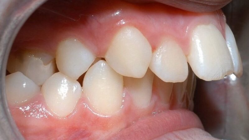 trước và sau khi niềng răng hô ra sao