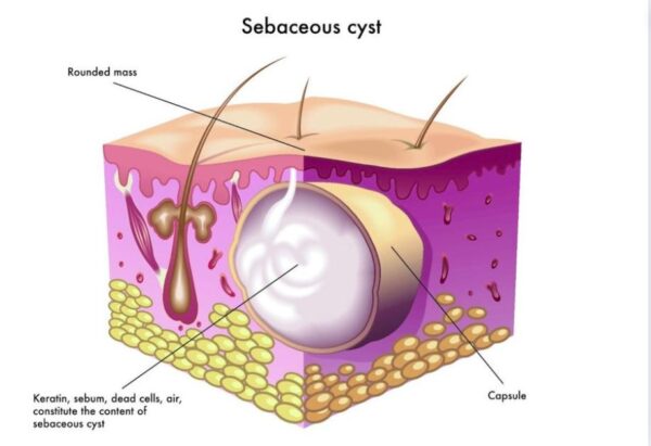Đặc điểm của u bã đậu