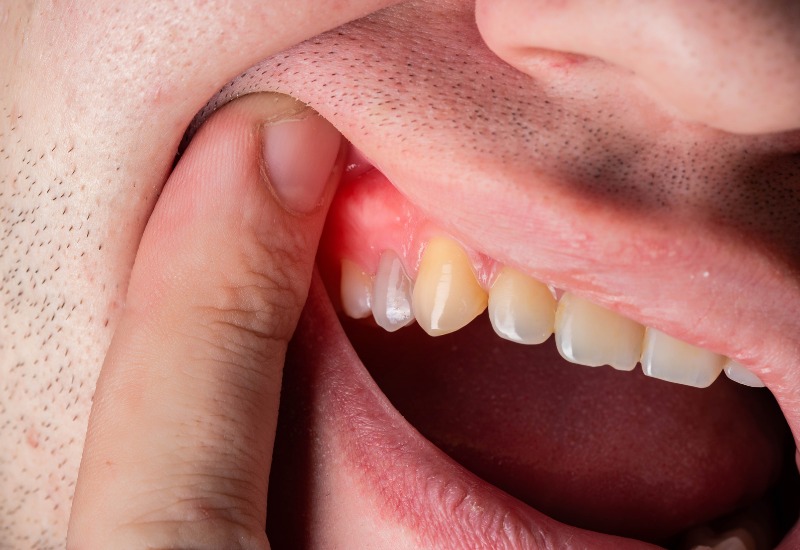 Lợi viêm thường sưng và chuyển sang màu đỏ tươi hoặc đậm hơn so với màu hồng khỏe mạnh thông thường.