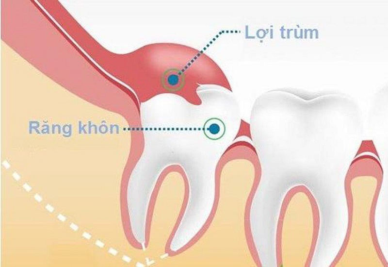 bệnh viêm lợi trùm răng khôn khi mang thai