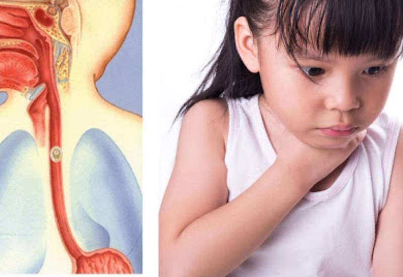 xử trí hóc dị vật thực quản thế nào