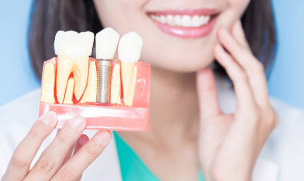 Tùy vào số lượng răng cần trồng mà chi phí sẽ khác nhau.