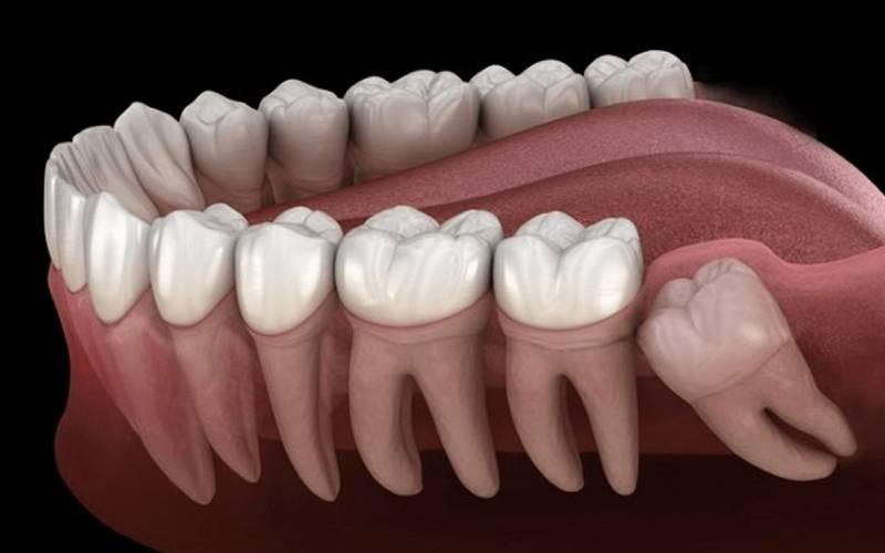 Hình ảnh khi Bị sưng nướu răng trong cùng hàm dưới