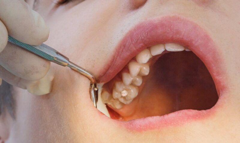 vì sao bị sưng nướu răng trong cùng hàm trên
