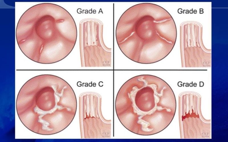 Các mức độ từ A - D