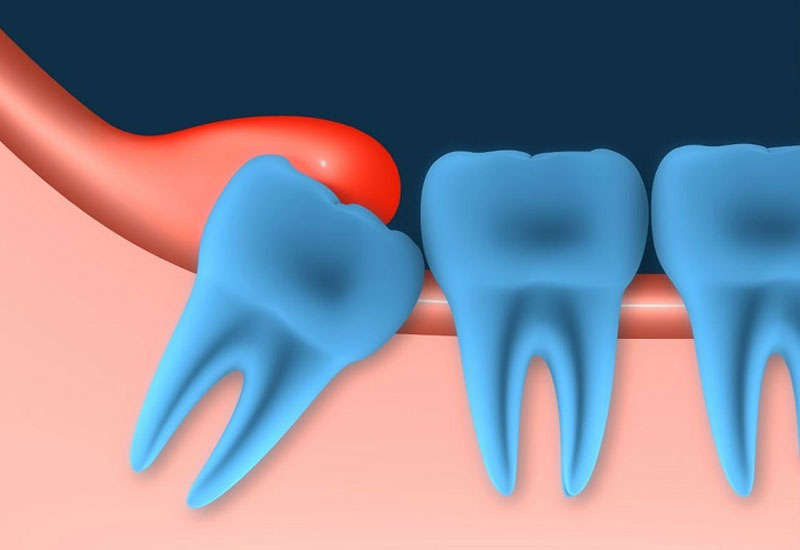 Tác hại Bị vôi răng 