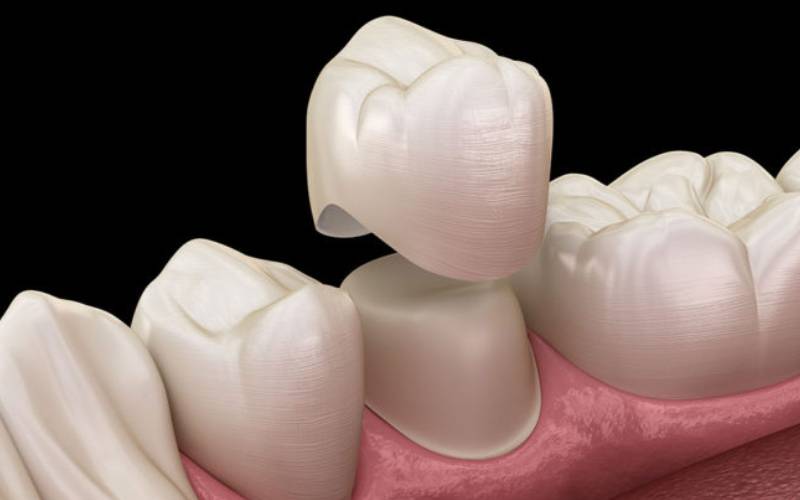 Bọc răng sứ bao nhiêu tiền có đắt không