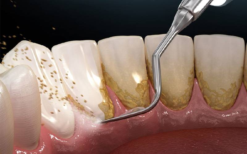 Cạo vôi răng giá thế nào