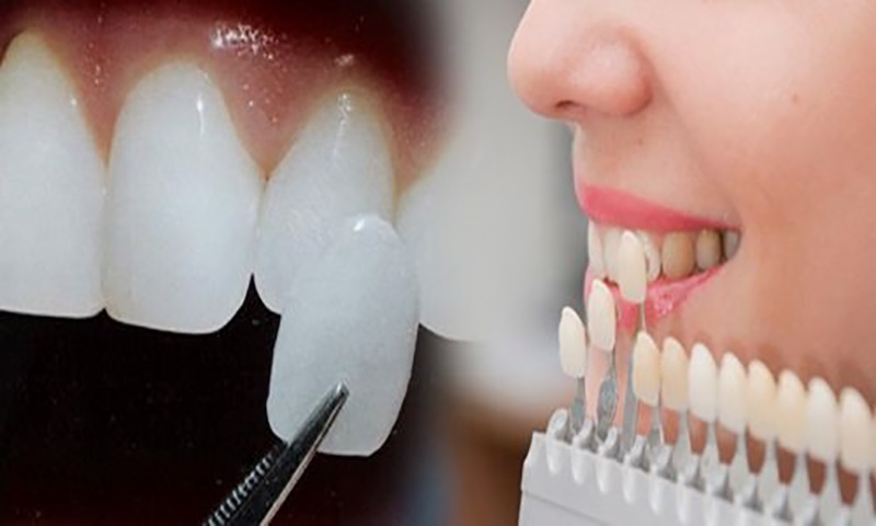 Có nhiều yếu tố có thể chi phối đến mức giá của việc dán sứ.