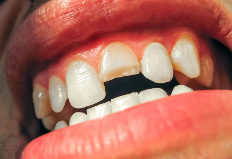 Răng mẻ không chỉ gây mất thẩm mỹ mà còn làm tăng nguy cơ sâu răng, viêm nướu và các vấn đề nghiêm trọng khác về răng miệng.