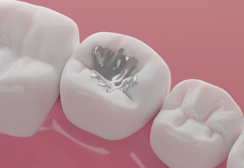 Những yếu tố ảnh hưởng đến chi phí hàn răng mẻ