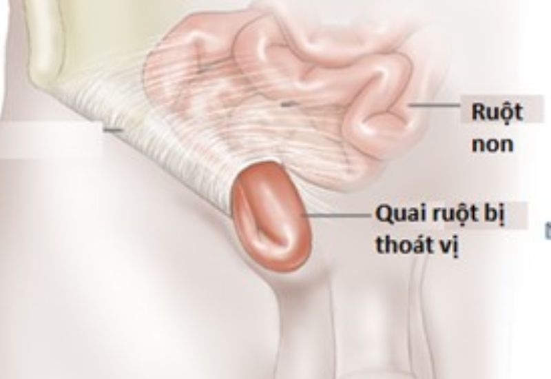 đừng tin chữa thoát vị bẹn không cần mổ