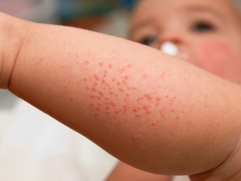 Phát ban do sốt virus